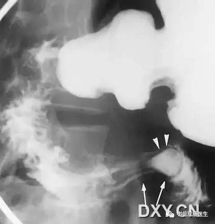 10种经典肠道影像征象详解