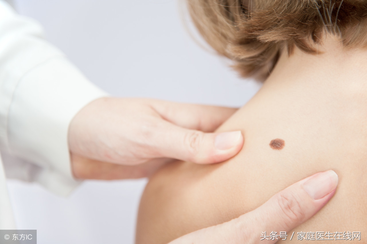 点痣之后怎么才能不留疤,点痣后留下了红印该怎么消除