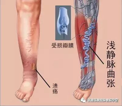 「杏林微科普」暴雨天，外出蹚水淋雨，小心得了脉管炎！