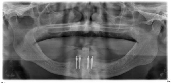 新加坡植牙介绍,新加坡植牙图片大全