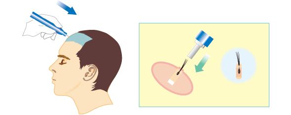 原来头发是绿的然后染橙色,种头发能和原来头发一样吗