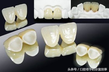 大部分人选择哪种烤瓷冠,一颗全烤瓷冠多少钱