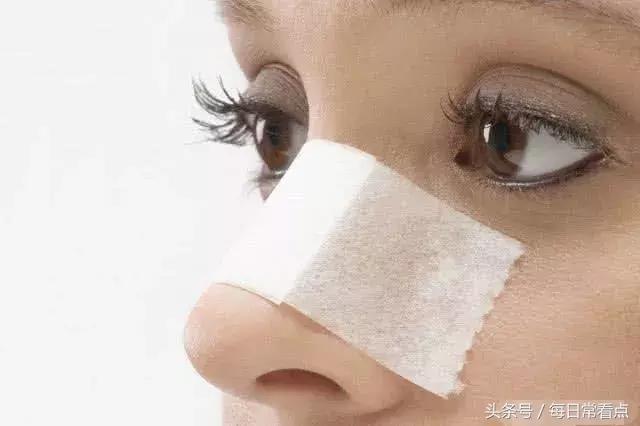 鼻子毛孔大黑头多什么办法去除,鼻子上黑头多毛孔大怎么简单去除