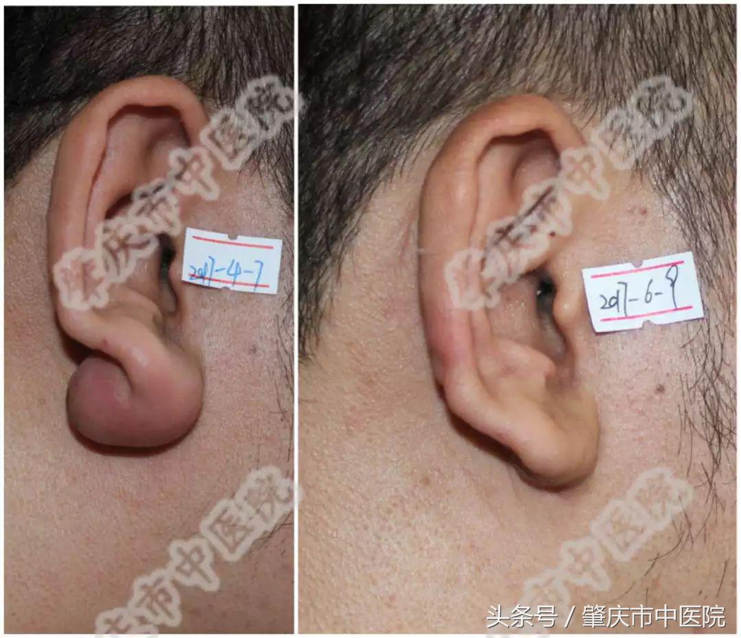 肇庆中医院激光治疗,激光切割生命之花