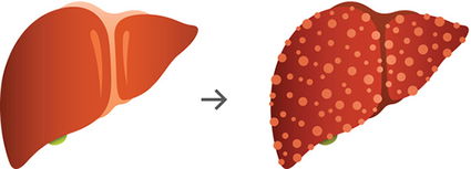 肝炎不治就会变肝癌吗,肝炎不治好会成癌吗
