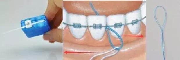 原来蛀牙是这样修复,牙齿开始蛀牙怎样防止恶化