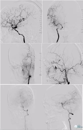 颈动脉闭塞介入治疗的风险,慢性动脉闭塞症病例