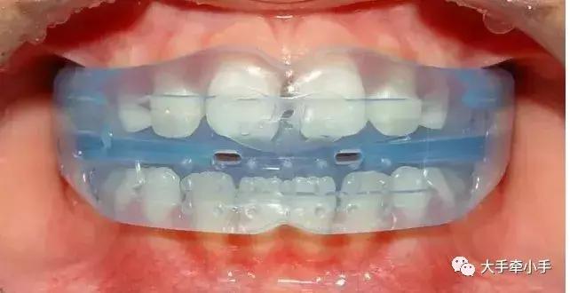 牙齿不齐矫正好还是做牙冠好,牙齿不齐矫正1个月的变化