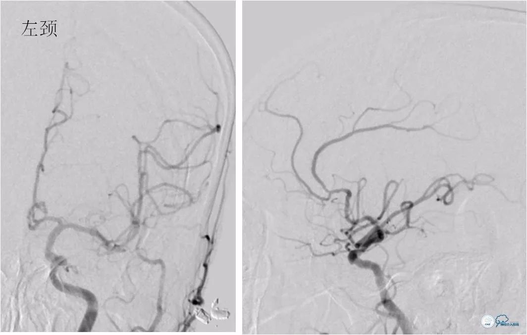 天坛周记｜左椎动脉开口及基底动脉串联狭窄血管内介入治疗1例