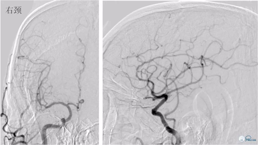 天坛周记｜左椎动脉开口及基底动脉串联狭窄血管内介入治疗1例