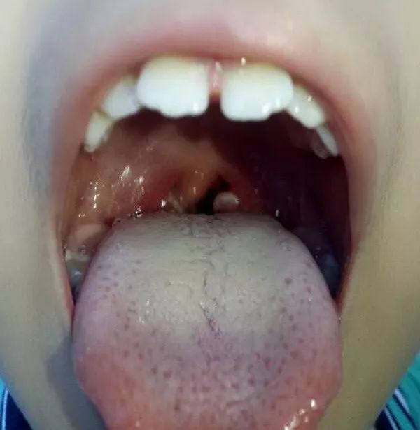 周期热综合征是什么病,儿童反复发热最高39.3