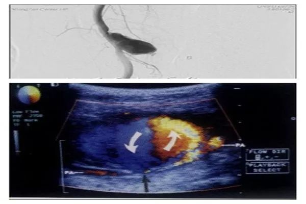 穿刺股动脉并发症,穿刺部位并发症预防及处理