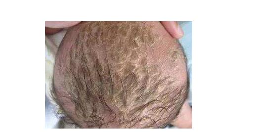 两个月宝宝老是抠头皮,宝宝便秘洁癖妈妈直接用手抠