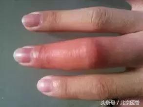 被蜂蜇伤的急救处理,被蜂类蜇伤如何急救课件