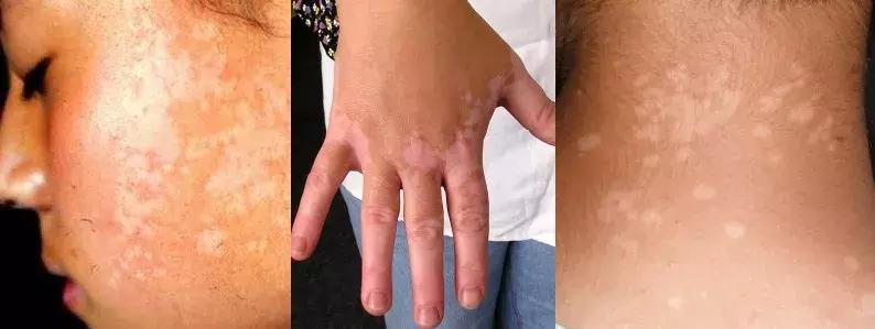 儿童脸上长白斑是什么原因引起,儿童脸上长白斑缺什么微量元素