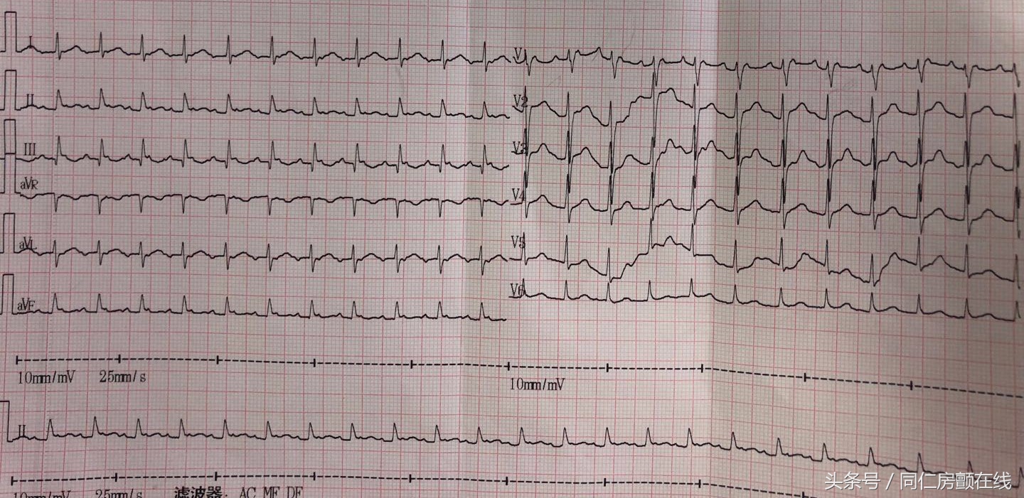 房扑是严重的心脏病吗,房扑与脑梗的联系