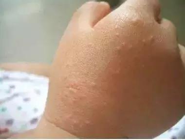 娃儿身上长“可可”该挂哪个科,妈老汉儿遇到这种情况最容易打蒙!