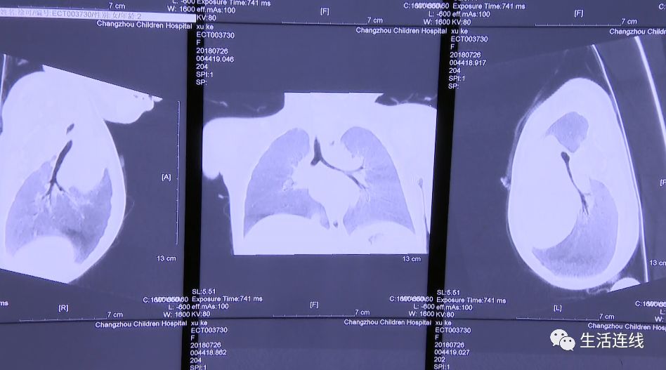 女童吃黄鳝,小孩误食黄鳝