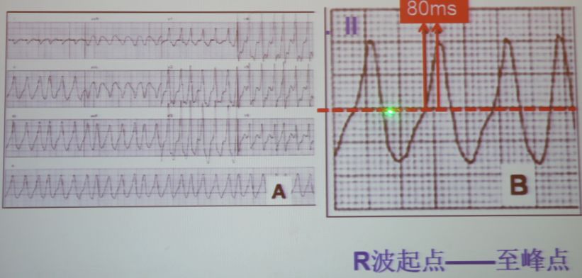 「CHC2018」郭继鸿：心电学进展2018