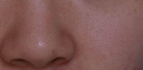 治疗毛孔粗大的护肤品,烟酰胺可以治疗毛孔粗大吗