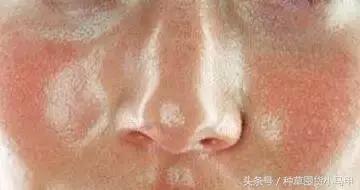 毛孔大和遗传有关系吗,脸出油有没有遗传关系