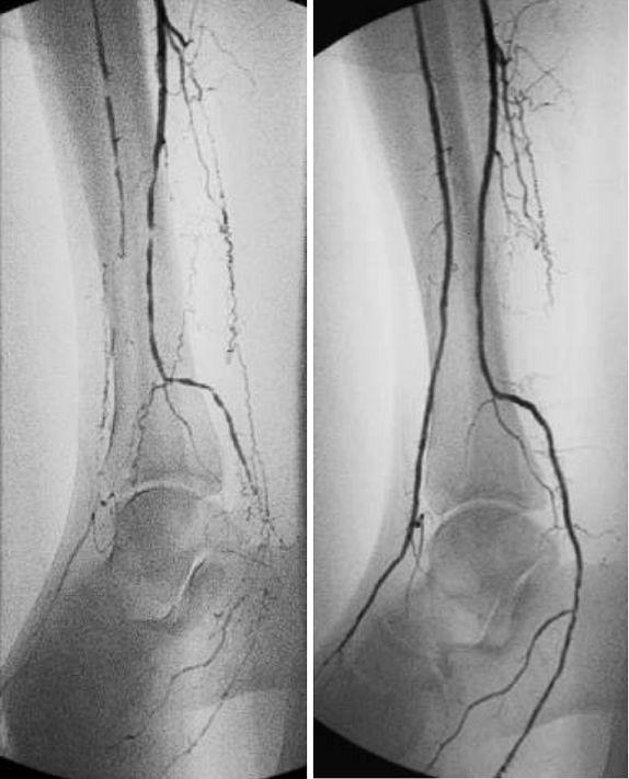 糖尿病下肢血管介入手术成功率,糖尿病下肢麻木中医辨证分析