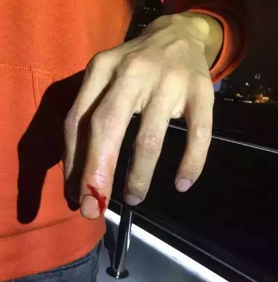 女子被虾刺到导致截肢,被虾扎伤伤口好了按压还是疼