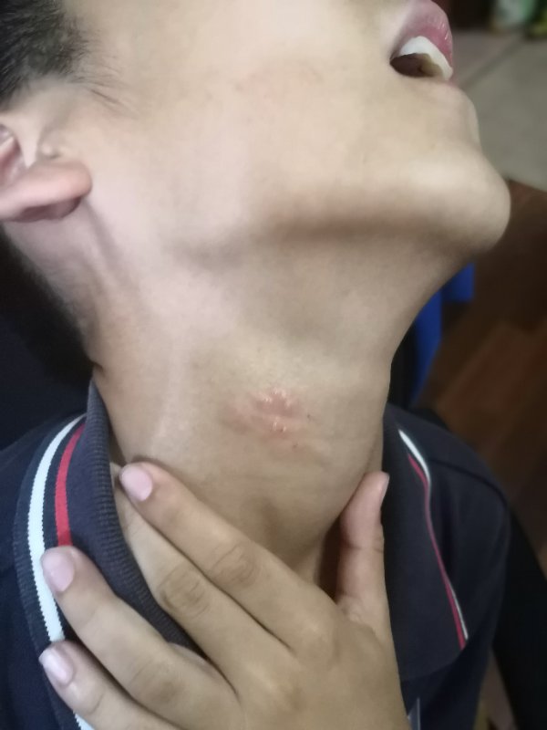 暑热季节湿疹的防治方法,夏季暑湿湿疹