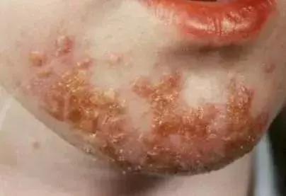 宝宝身上一大片的包是怎么回事,宝宝身上好多片包