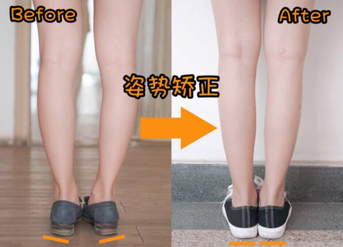 如何矫正足外翻和o型腿,走路足内翻怎么矫正