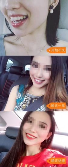 速看！刚刚发布大消息！8月起牙齿矫正、种植牙这10项费用全免！