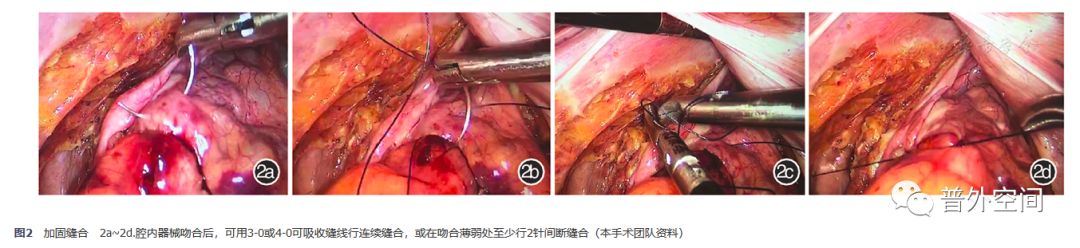 直肠癌吻合口瘘引流管,直肠癌术后吻合口瘘的护理