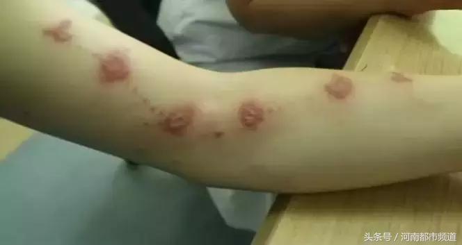 警惕！小伙在树底下玩手机，结果整条手臂出现成串“脓包”！