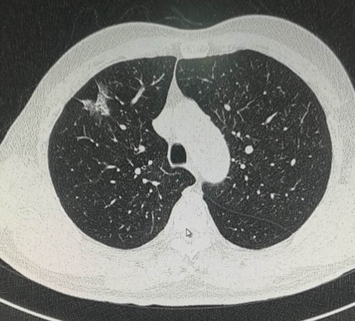 磨玻璃肺结节手术后需要化疗吗,2.5厘米肺结节微创手术后要化疗吗
