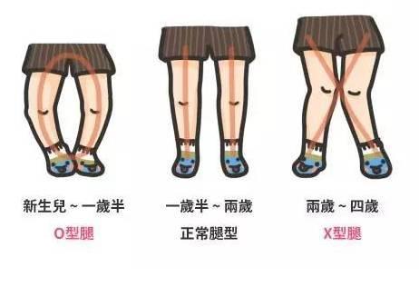 宝宝不缺钙o型腿可以补钙吗,宝宝o型腿补钙好不好