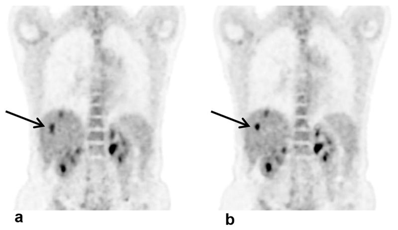 ibm沃森人工智能医疗最新状况,ibm沃森最新视频
