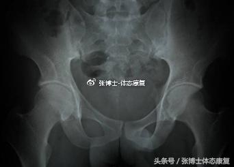 运动康复科普强直性脊柱炎,强直性脊柱炎腰部锻炼康复方法