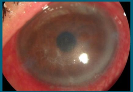 角膜上皮细胞损伤多久能恢复,治疗角膜上皮细胞损伤全国专家