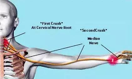 手麻痛不灵活，当心神经损伤！发现得越早，恢复得越好！