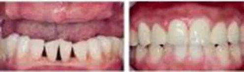 种植牙能降价多少钱啊,牙齿种植牙价格一览表