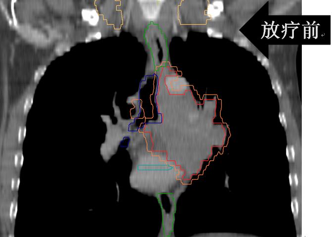 安罗替尼治小细胞肺癌吗,卡瑞利珠能治小细胞肺癌吗