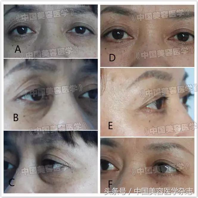 外眦悬吊固定视频操作方法,眼睑松弛矫正手术术前设计方案