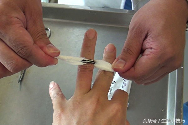 戒指卡住手指怎么办？医生1招轻松取下