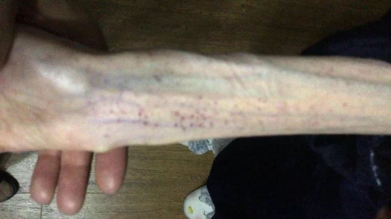 1米67才50斤！21岁女孩“自杀式减肥”，照片不忍直视……