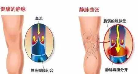缓解静脉曲张最有效的八种办法,静脉曲张别担心教你9招有效缓解