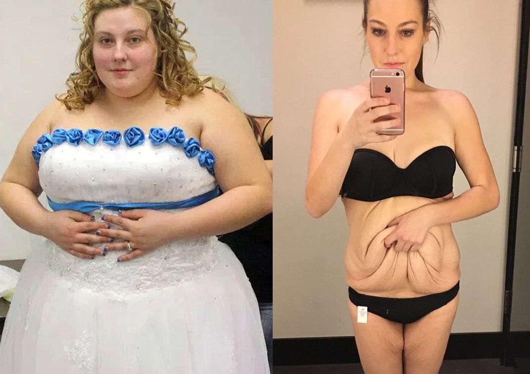 瘦了200斤,身体很多赘皮,怎么办?