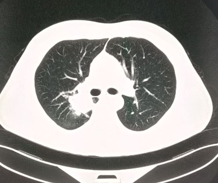 肺癌手术后胸腔内有碎肉怎么办,肺癌切除手术后有个空腔