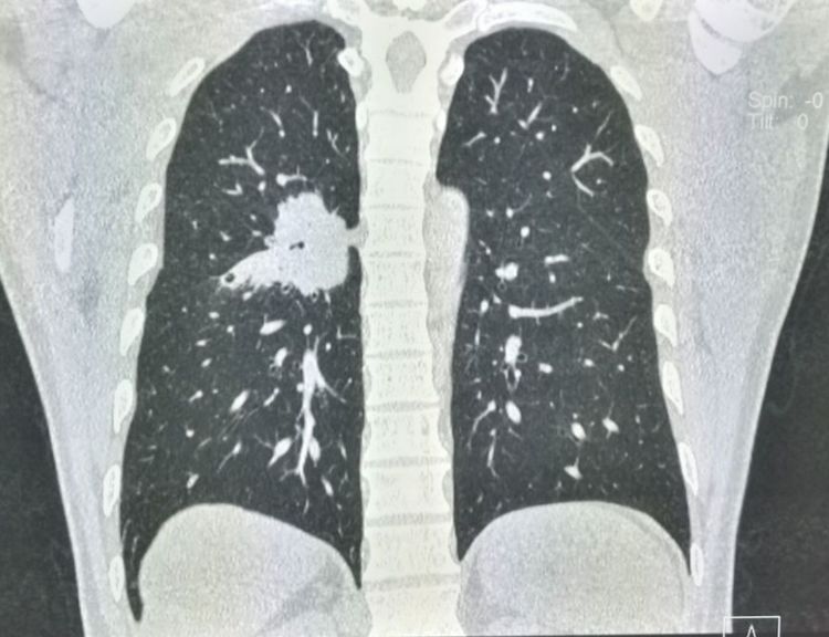 肺癌手术后胸腔内有碎肉怎么办,肺癌切除手术后有个空腔