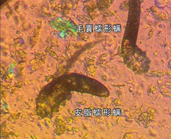 背上螨虫痘去除过程,螨虫引起的前胸后背痘痘怎么治疗