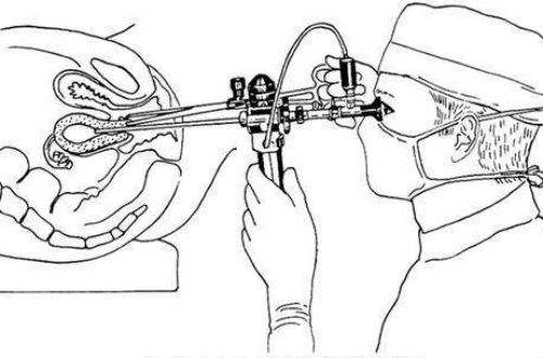 妇科专家教你认识宫腔镜,科普妇科专家带你认识宫腔镜